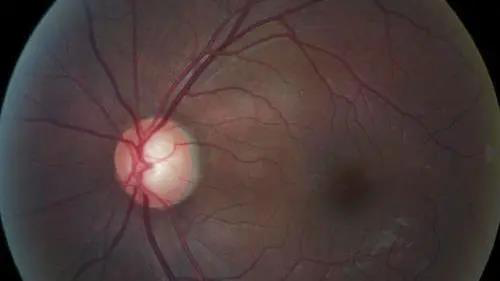 青光眼的克星来袭，助力患者远离视力的“窃贼”