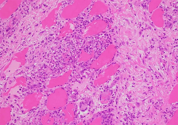 【esball助力】医治结节病的KBMAB-16获FDA核准临床